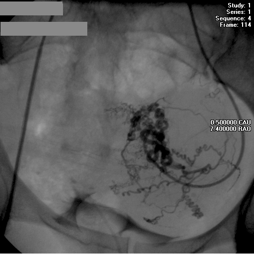 Ангиограмма: катетер установлен в левой маточной артерии.