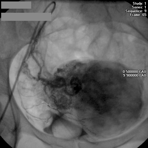Ангиограмма после эмболизации правой маточной артерии.