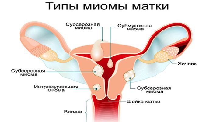 Узел матки при беременности