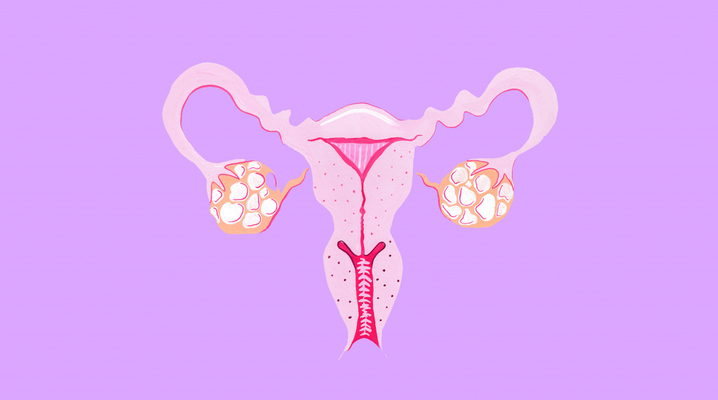 Whats-a-hysterectomy-and-why-do-women-get-them_2.jpg